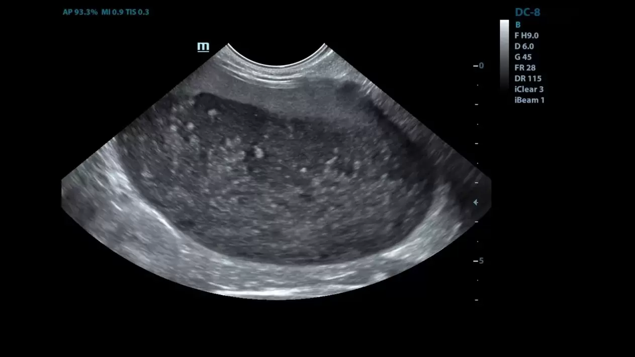 Zystitis in meinen Ultraschallbildern vor der Verwendung von Cystolax