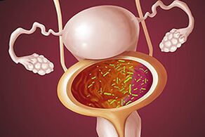 Bakterielle Zystitis bei einer Frau.