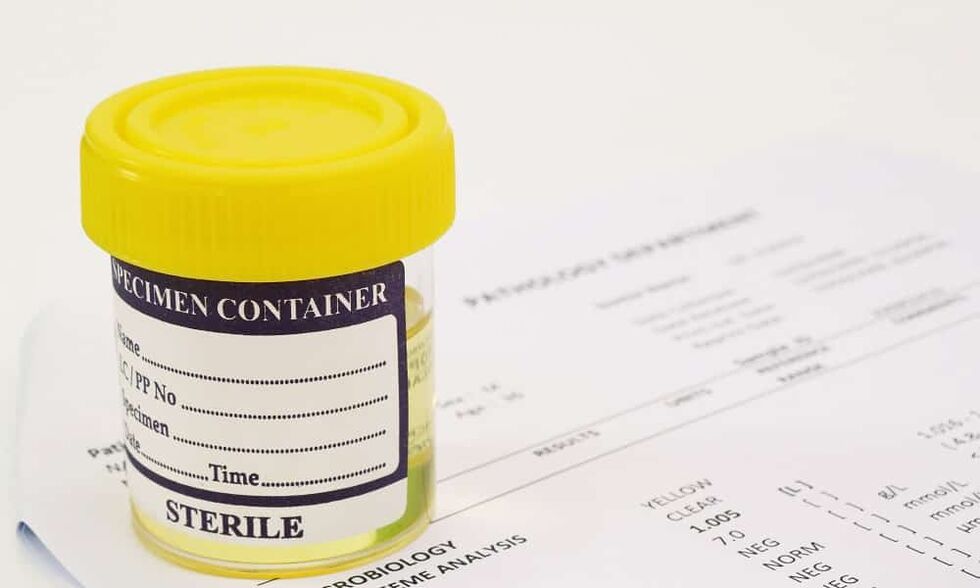 Bevor Sie Antibiotika einnehmen, sollten Sie einen Urintest durchführen lassen.